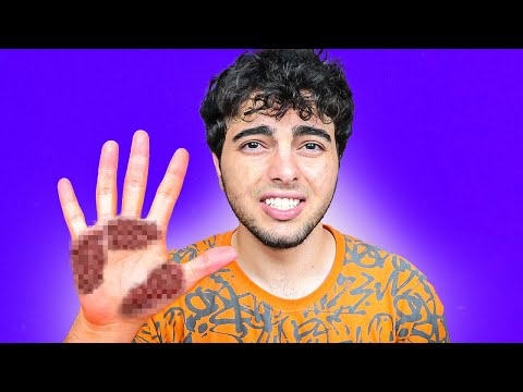 ELİME NE OLDU? NEDEN ELDİVEN TAKIYORUM? *Üzgünüm*