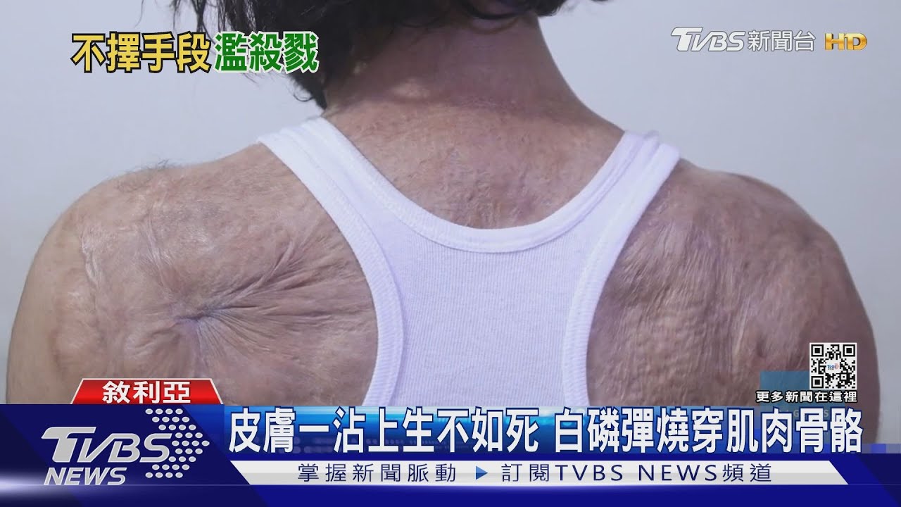 膚燒如剝洋蔥　俄疑用化武「白磷彈」下一步恐爆核戰