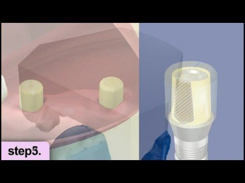 Dental implants procedure video - restoration