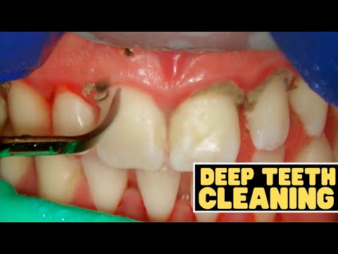 YouTube video about: How many dental cleanings per year?