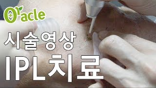 효과 좋은 피부 레이저 시술 팩폭 (IPL ? 프락셀? 토닝?)