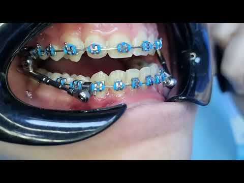 Orthodontic  powerscope 2 Herbst appliance