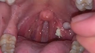How to remove Tonsil Stones? | 4 different cases | Tonsilloliths