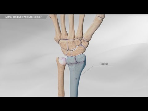 Distal Radius Fracture Repair