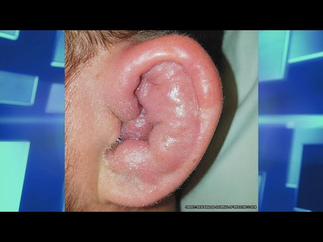Video Pronunciation of cauliflower ear in English