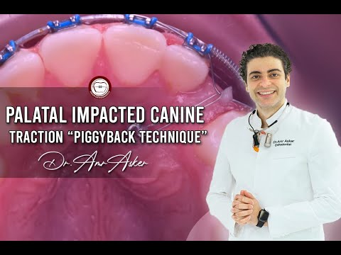 treatment of impacted canine, step by step piggyback double wire mechanics