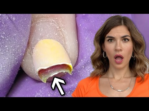 Bitten Nails Transformation with Poly Gel | Thick Product Removal