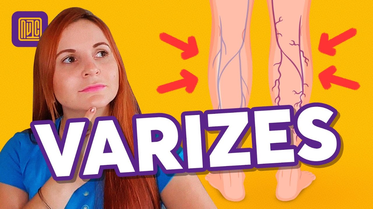 Por que surgem e como tratar as VARIZES?