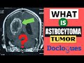 What is Astrocytoma Tumor?