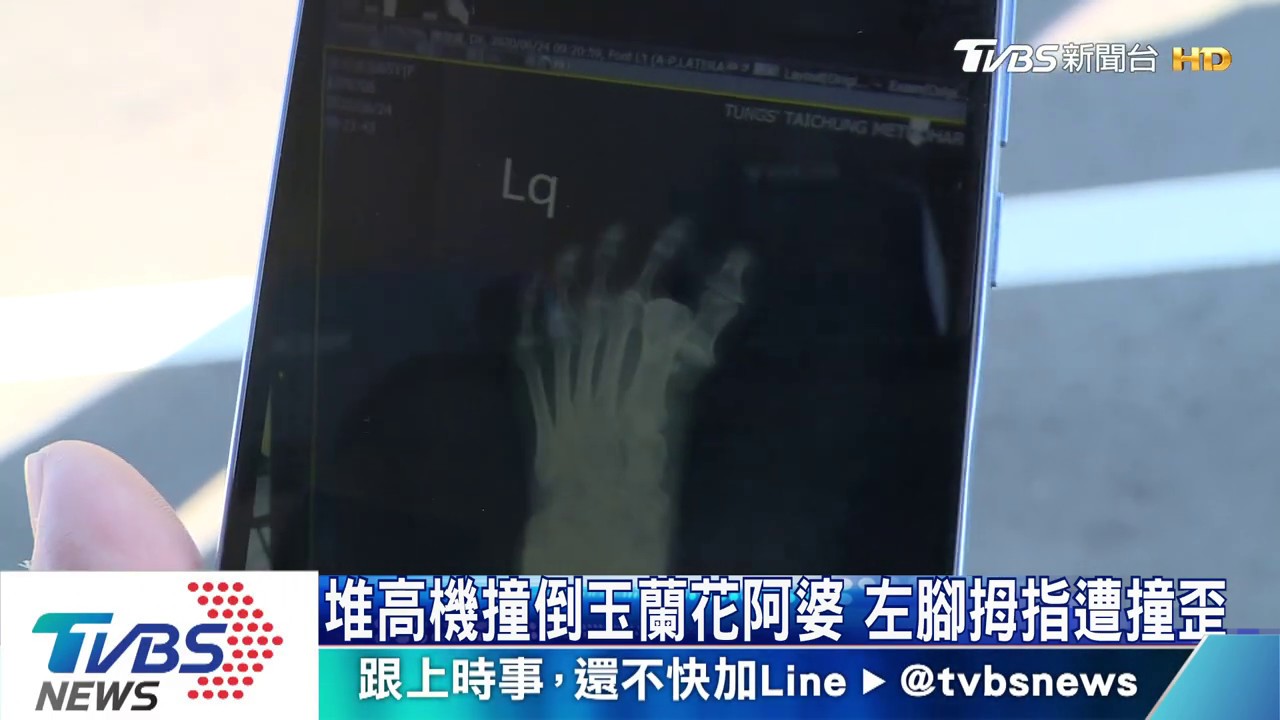 堆高機撞倒玉蘭花阿婆　左腳姆指遭撞歪