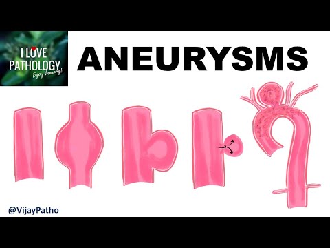 ANEURYSMS- Types , Pathogenesis & Abdominal aortic aneurysm