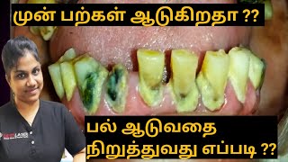 முன் பற்கள் ஆடுவதற்கான  காரணங்கள், தீர்வுகள்/ Loose teeth and its solutions in tamil