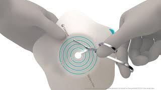 Product video: SenSura Mio Convex Flip 2-Piece Click Ostomy Barrier