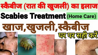How to treat Scabies/SCABIES treatment  Home #Scabies 