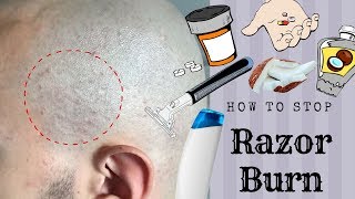 HOW TO STOP RAZOR BUMPS/BURN *Head Shave