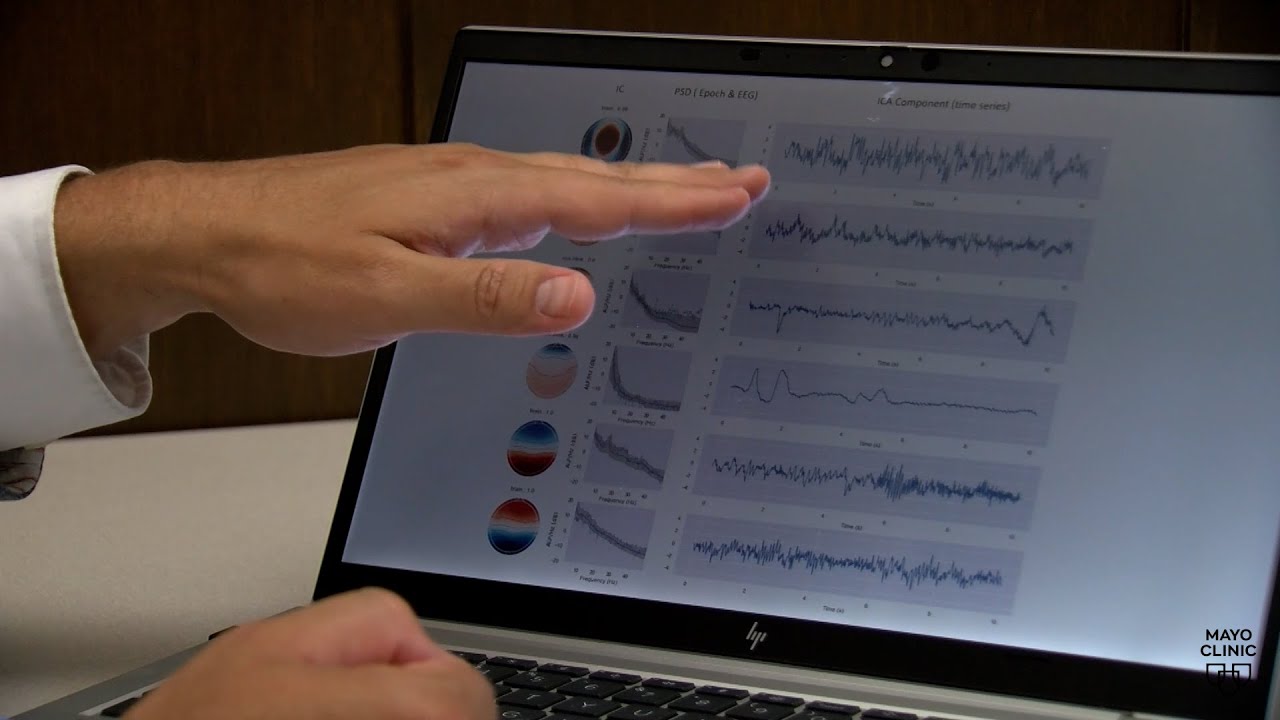 Mayo Clinic Minute: Using AI and brain waves for early diagnosis of neurodegenerative diseases