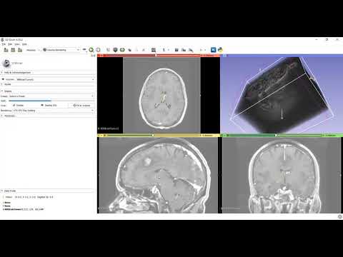 Volume rendering and ROI on brain tumour using 3D Slicer