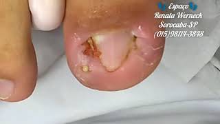 Unha encravada e suas surpresas!