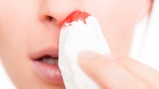 How to Treat a Nosebleed | First Aid Training