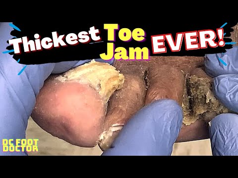 Thickest Toe Jam Ever! Big Build-up Between The Toes and Fungal Toenails