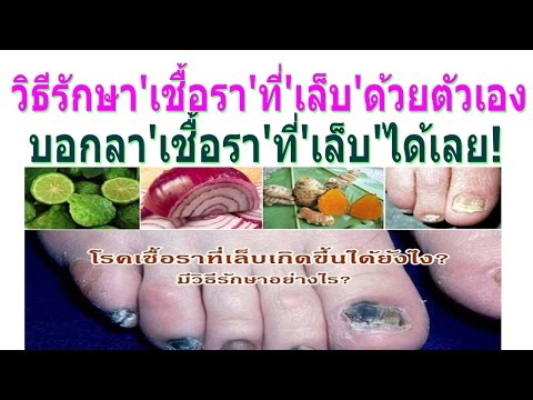 กลากที่เท้าของเขาที่จะซื้อ กลากเย็นบนมือรูปภาพของเขา