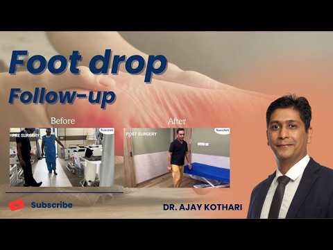 Foot Drop Follow-Up Patient: Recovery Progress & Care Explained | Dr. Ajay Kothari