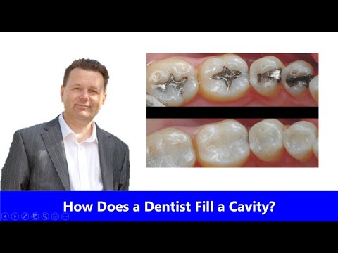 How Does a Dentist Fill a Cavity?