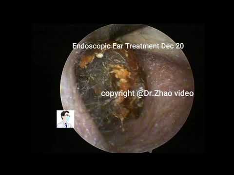 Ear wax removal，Re examination and cleaning of...