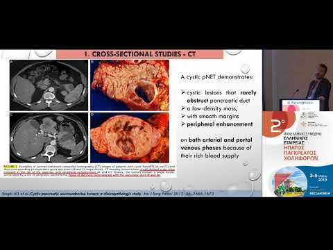 Παραμυθιώτης Δ. - Cystic pancreatic neuroendocrine tumors