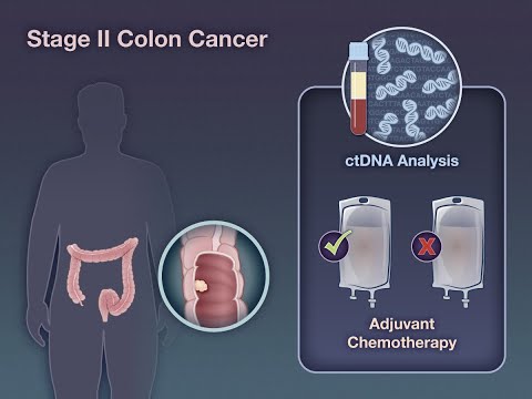ctDNA-Guided Therapy in Stage II Colon Cancer | NEJM