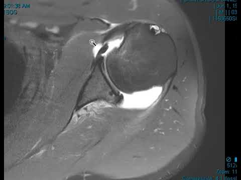 Posterior shoulder dislocation with reverse Hill Sachs deformity