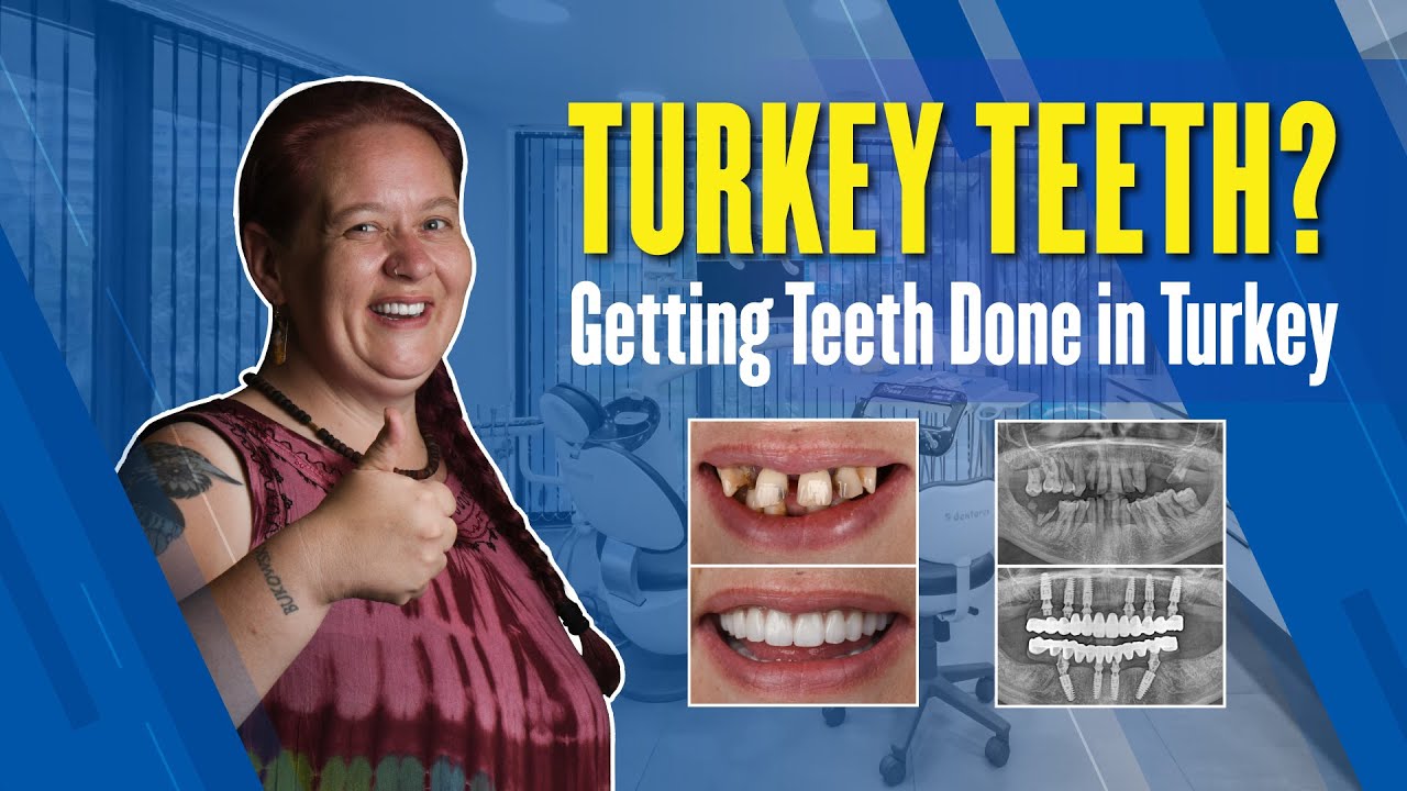 Turkey Teeth?! | Not Great a Fan of NHS! I Got My Teeth Done in Turkey 2022