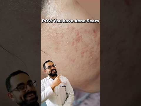 POV: You Have Acne Scars 😨 #acnefree #brightskin
