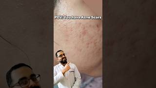 POV: You Have Acne Scars 😨 #acnefree #brightskin