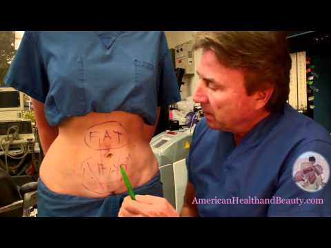 lefogy a smartlipo