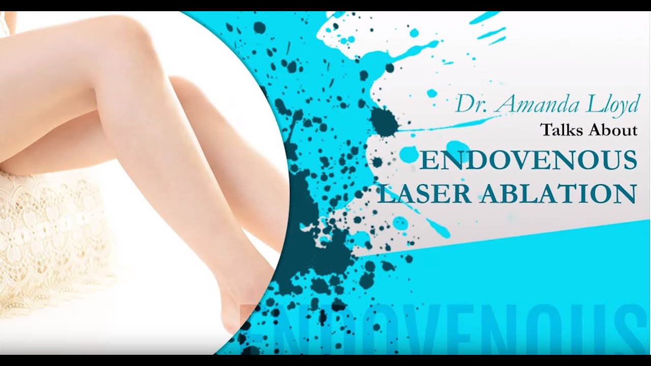 Endovenous laser ablation - Encinitas CA