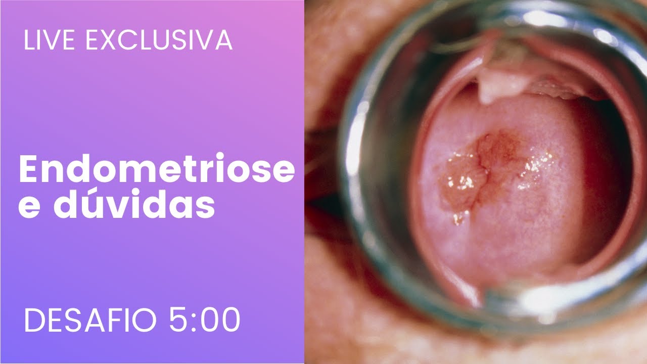 Endometriose profunda, Live de tira dúvidas