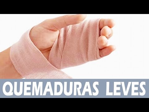Remedios caseros para quemaduras leves: cómo calmar el dolor