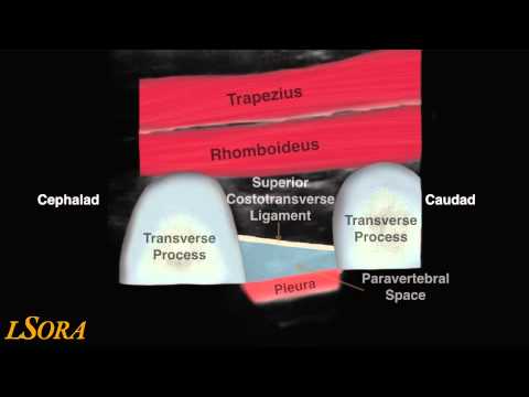 Lsora Paravertebral Block Us Guided Tutorial