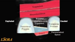 LSORA: paravertebral block (US guided) tutorial