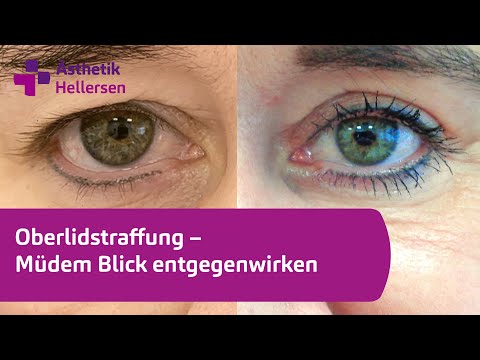 Oberlidstraffung – Müdem Blick entgegenwirken