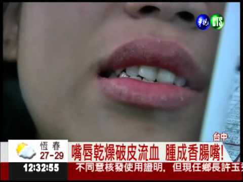 "咬嘴"檸檬乾! 唇脫皮變香腸嘴