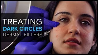 Treating Dark Circles with Dermal Fillers