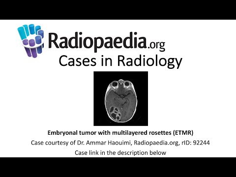 Embryonal tumor with multilayered rosettes (ETMR) (Radiopaedia.org) Cases in Radiology