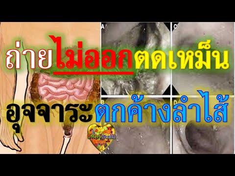 บาร์เพิ่มเต้านม สัมผัสหน้าอกซิลิโคน