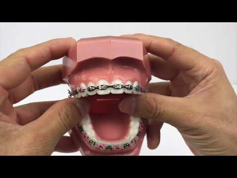 How Do Braces Close Gaps Between Teeth 2018