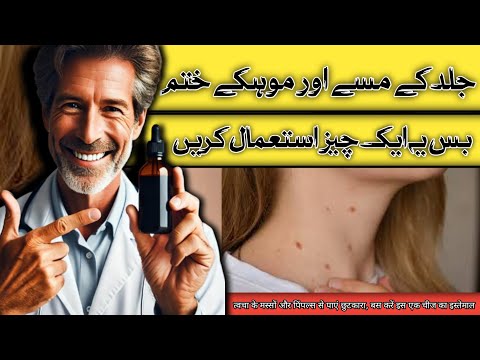 Use Iodine for Skin Tags and Warts || डॉक्टर ज़ी ||👨🏻‍⚕Dr.Kashif Bilal