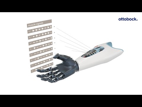 Ottobock Myo Plus pattern recognition: The AI control for myoelectric arm prostheses | Ottobock