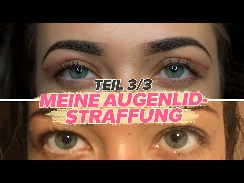 Meine AUGENLIDSTRAFFUNG [ Teil 3/3 ] - Vorher-Nachher ohne Schlupflider 😻