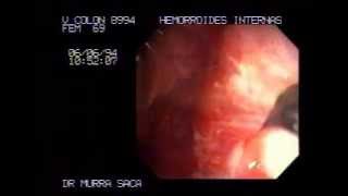Video Hemorrhoids rubber band ligation 1